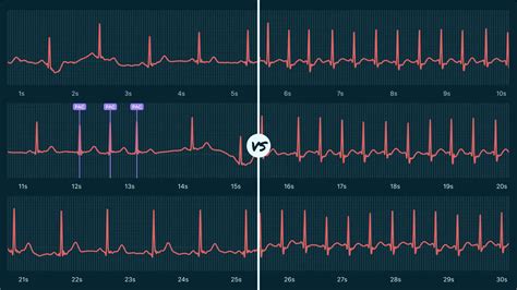 Ectopic Atrial Rhythm Vs. Atrial Fibrillation on Your Watch ECG | Qaly