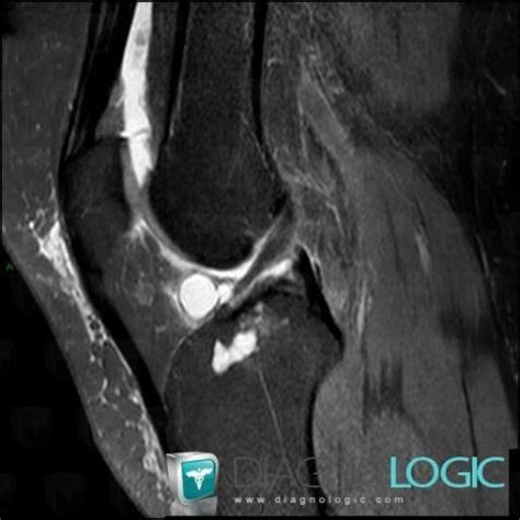 Cas Radiologie Kyste Muco De Irm Diagnologic