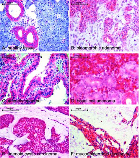 All Examined Types Of Parotid Gland Tumors Showed Intense Download