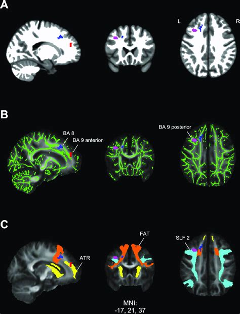 Localization Of Frontal Task Related FMRI Activations In White Matter