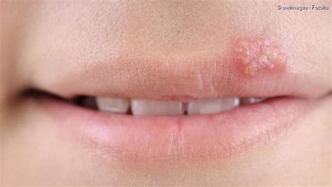 Herpes Behandlung Der Herpes Formen NetDoktor At