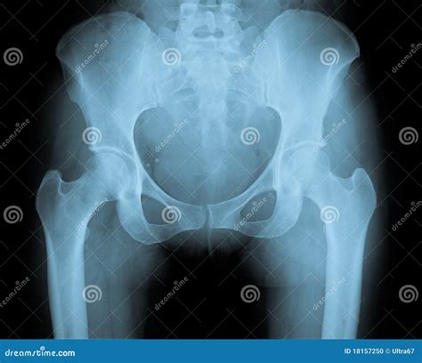 Pelvis X Ray Stock Photo - Image: 18157250