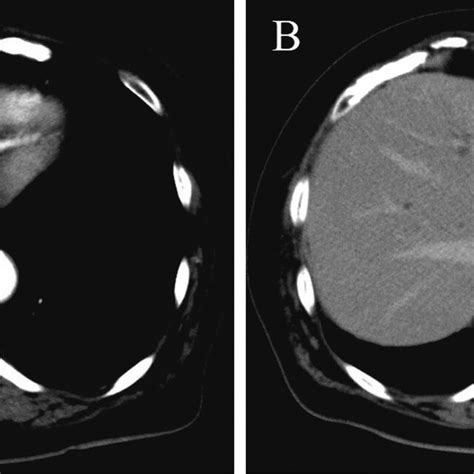 Abdominal Contrast Enhanced Computed Tomography A Lesion Measuring