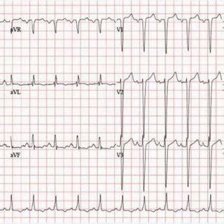 Ecg Showing Sinus Tachycardia Left Atrial Enlargement T Hot Sex Picture