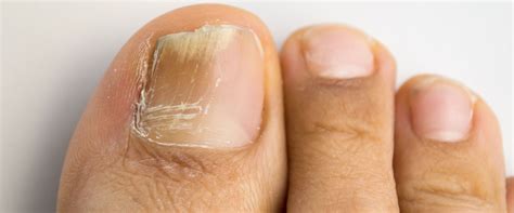 Understanding Toenail Fungus Causes Treatments And Prevention