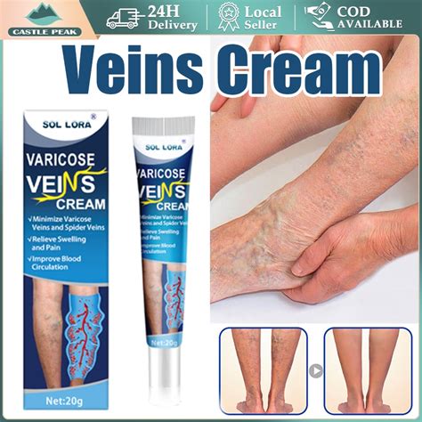 Jual Varicose Veins Obat Varises Di Kaki Dan Betis Paling Ampuh Salep