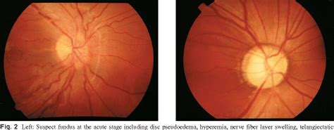 Figure From Clinical Features Of Leber S Hereditary Optic Neuropathy