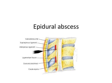 Epidural abscess