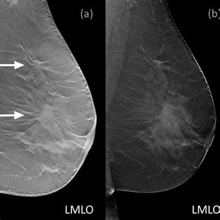 A 50 Year Old Patient With Multifocal Bifocal Invasive Ductal