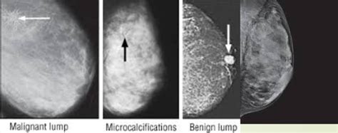 Dense Breast Is Dense Breasts A Risk Factor For Breast Cancer