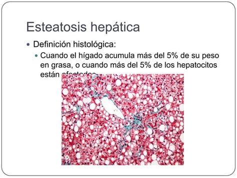 Enfermedad De Hígado Graso No Alcohólico Ppt