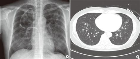 A Chest Radiograph Showing Bilateral Ground Glass Opacity And Patchy Download Scientific