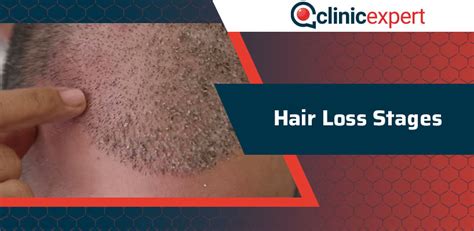 Hair Loss Stages | ClinicExpert