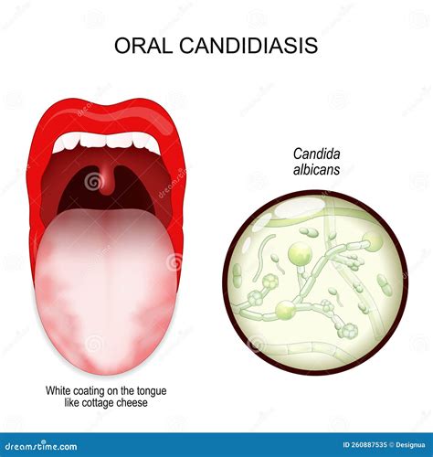 Oral Candidiasis Oral Thrush Yeast Infection Stock Vector