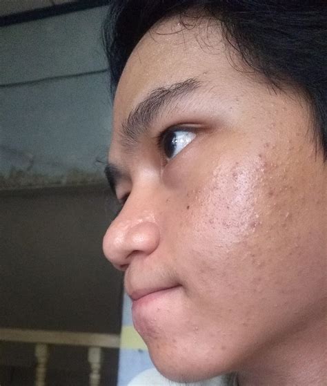 [Acne] Please help me how to cure Comedonal Acne : r/SkincareAddiction