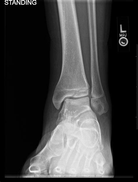 Oblique Fracture X Ray