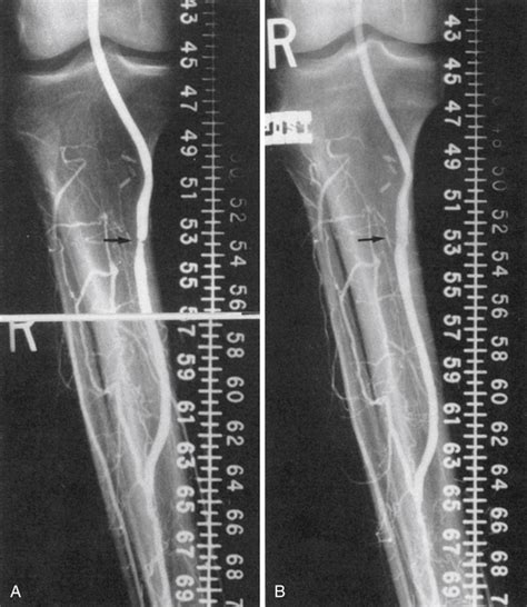 Axillofemoral Bypass Thoracic Key