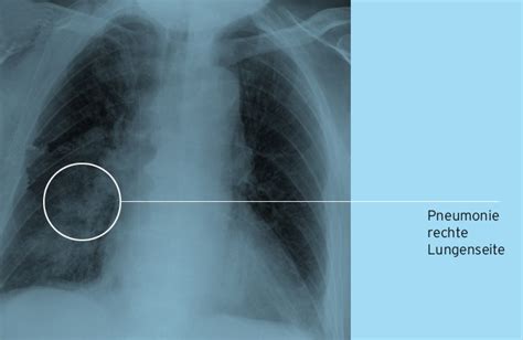 Lungen Und Atemwegsinfektionen Klinikum Kulmbach