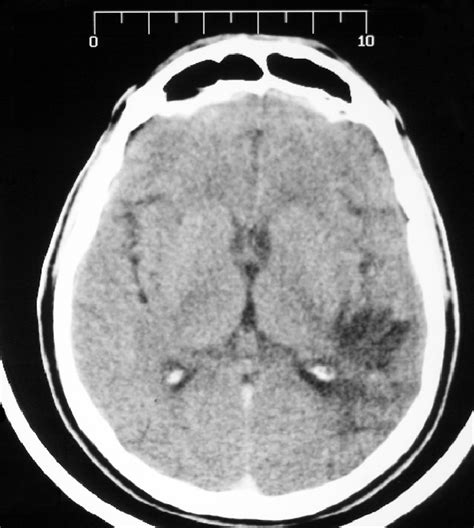 Ct Image Demonstrating Left Occipito Parietal Hypodense Lesion Download Scientific Diagram