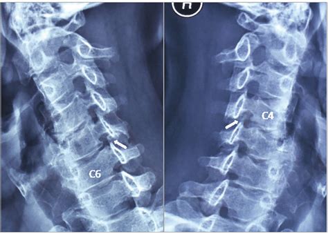 Cervical Stenosis X Ray