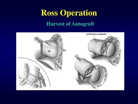 PPT - Ross Operation PowerPoint Presentation, free download - ID:4813686