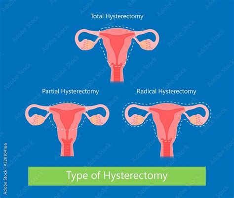 Laparoscopic Hysterectomy Medical Surgical Treat Cervix Ovary Subtotal Minimally Invasive