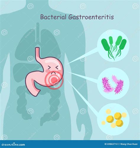 Gastroenteritis Vector Illustration | CartoonDealer.com #72963888
