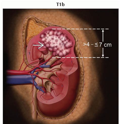 Renal Carcinoma Radiology Key