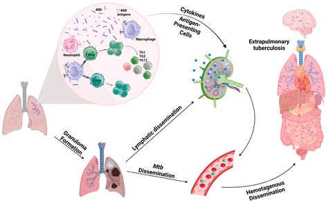 extrapulmonary tuberculosis