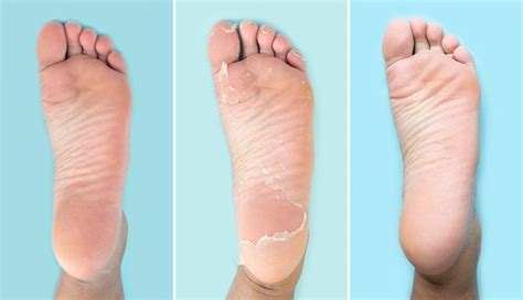 Baby Foot Review: 5 Women Tried It, and the Results Were Both ...