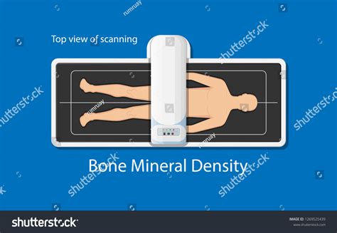 Bone Mineral Density Bmd Osteoporosis Dual