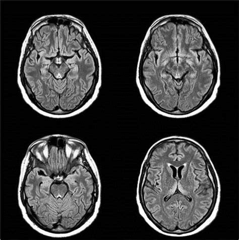 Wernicke S Encephalopathy Refeeding Syndrome And Wet Beriberi After