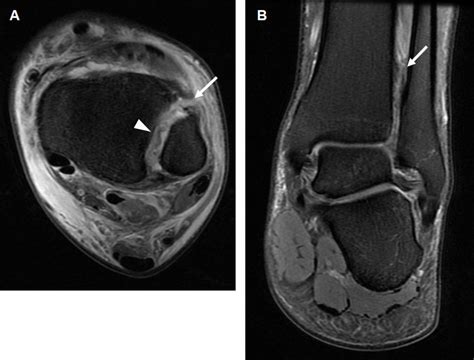 Acute Syndesmosis Injury A Axial Pd Fs Image Showing Complete