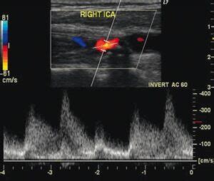 Carotid Artery Stenosis The Operative Review Of Surgery