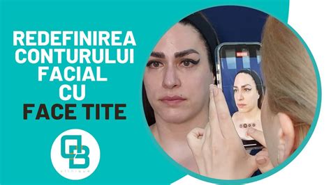 Redefinirea Conturului Facial Cu Facetite Dermabeauty Clinique Youtube