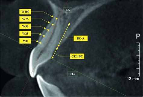 Dimensions Measured In The Study Cejbc The Distance From The