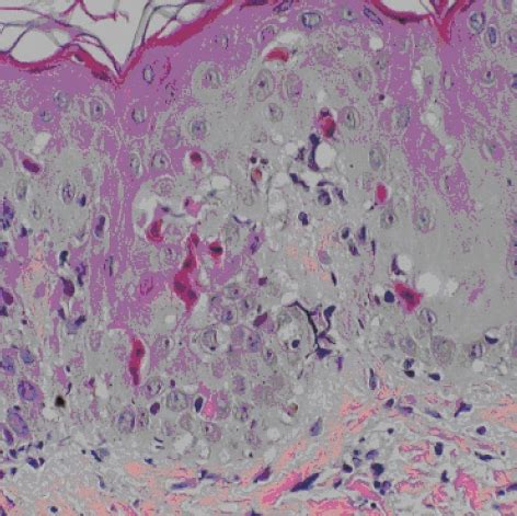 Histopathological Findings Of Skin From A Patient With Pre Engraftment