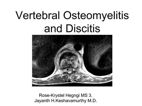 Discitis And Osteomyelitis In Sickle Cell Disease PPT