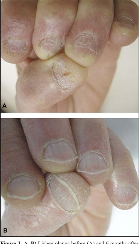 Nail Lichen Planus Response To Treatment And Long Term Follow Up