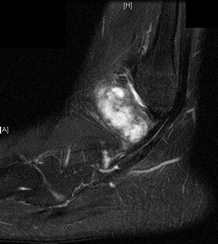 Synovial Sarcoma