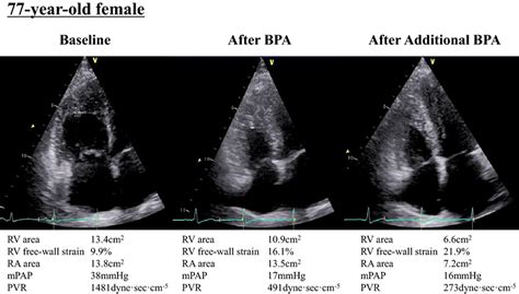 Representative Case Of Rv Focused Apical 4 Chamber View At End Systole