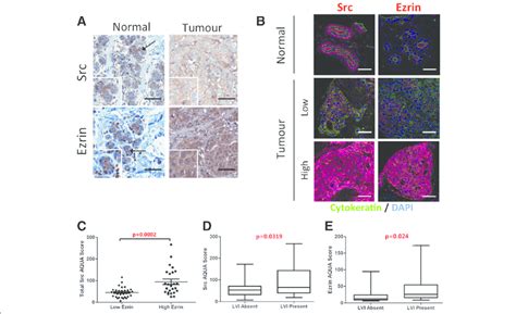 Src And Ezrin Expression In Human Breast Cancer A Ihc Staining Of