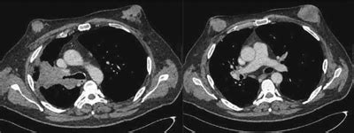 Bilateral Metastatic Gynecomastia From Small Cell Lung Tumors In A Man