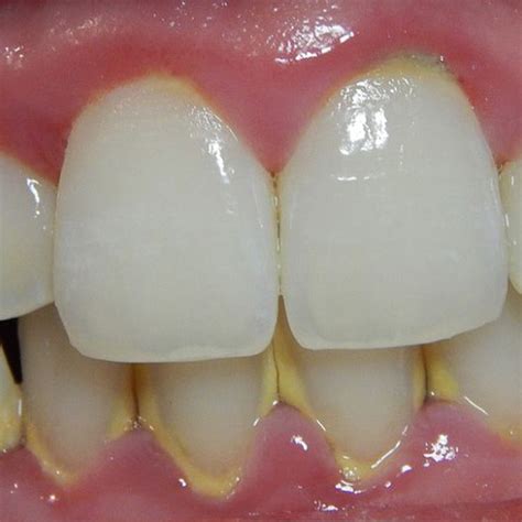 Tártaro no dente Causas Como remover Prevenção