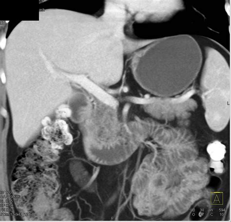 Focal Fatty Infiltration Of The Pancreas Simulates A Mass Pancreas