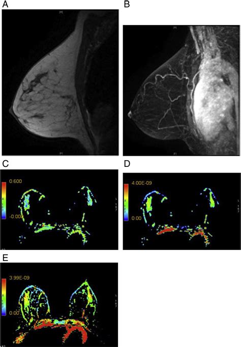 Diffusion Tensor Imaging In The Normal Breast Influences Of