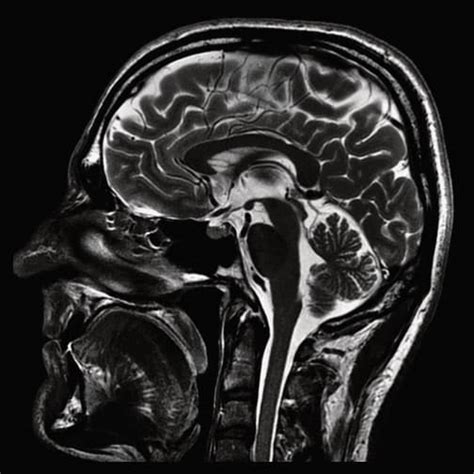 Brain MRI - Insight Medical Imaging