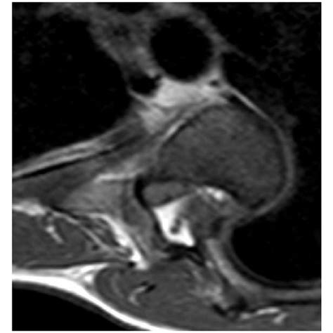 Preoperative Whole Spine Ap And Lateral X Ray A Preoperative Ct B Download Scientific