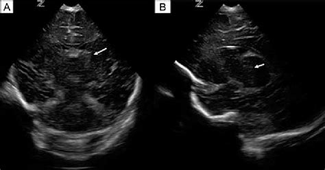 A Coronal And B Parasagittal Ultrasound Images Showing Unilateral