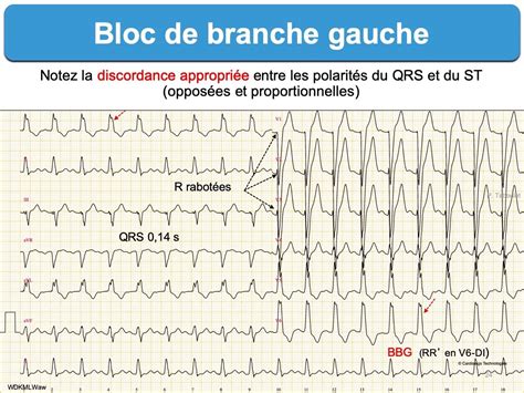 Bloc De Branche 3 Gauche Complet E Cardiogram